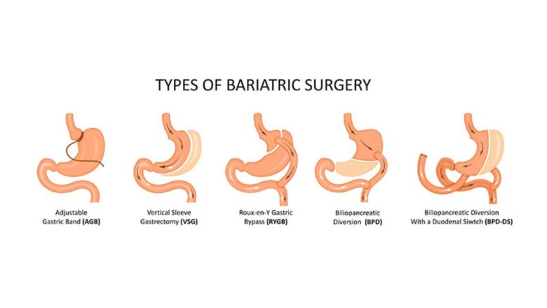 types-of-bariatric-surgery
